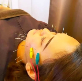 緑が丘はり灸治療院 美容鍼のメニュー画像