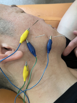 鍼灸整骨カラダステーション 顔面神経麻痺のメニュー画像