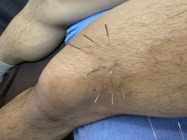 北京堂中目黒(くぎぬき鍼灸院) 膝の痛みのメニュー画像