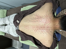 アディオ鍼灸カイロプラクティック ルート治療（30分のメニュー画像