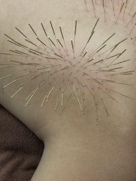 【ルート治療専門鍼灸院】鍼侍 ルート治療ロングのメニュー画像