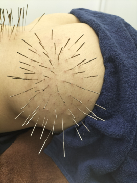 【ルート治療専門鍼灸院】鍼侍 ルート治療スタンダードのメニュー画像