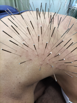 【ルート治療専門鍼灸院】鍼侍 ルート治療ショートのメニュー画像