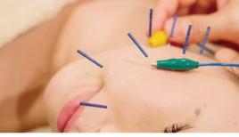 はり・きゅう整骨院　からださぽーと 美容鍼のメニュー画像