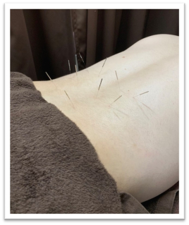 吹田鍼灸整骨院 鍼灸のメニュー画像