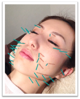 吹田鍼灸整骨院 美容鍼灸のメニュー画像