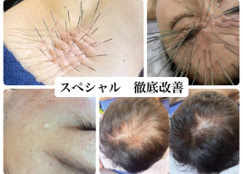 鍼処SHIRAKAWA京都院《ルート治療専門院》烏丸線北大路駅 スペシャル  徹底改善 ルート治療のメニュー画像