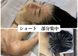 鍼処SHIRAKAWA京都院《ルート治療専門院》烏丸線北大路駅 ショート 部分集中 ルート治療のメニュー画像