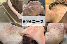 はり処もり　(ルート鍼専門院) 標準治療(基礎改善)のメニュー画像