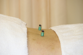 岡接骨院・鍼灸院 のぼせ（気逆）のメニュー画像