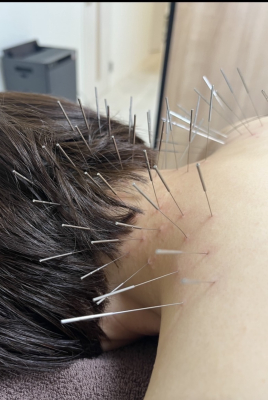 鍼処FUJINUMA 栃木院 ルート治療　15分のメニュー画像