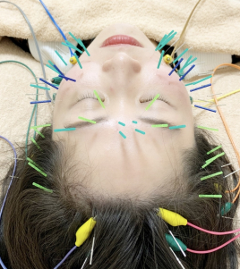 白牡丹はりきゅう院 リフトアップに特化した美容鍼のメニュー画像