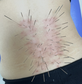 鍼処FUJINUMA 東京院 ルート治療　30分のメニュー画像