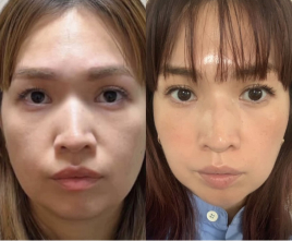 鍼処FUJINUMA 東京院 ルート鬼美容鍼　15分のメニュー画像