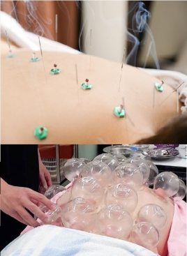 やわらげ鍼灸room 鍼灸吸玉カッピング療法60分のメニュー画像