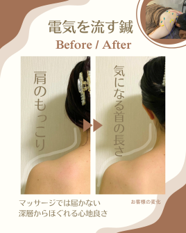 Harry鍼灸院 肩もっこりさよなら【電気を流す鍼】のメニュー画像