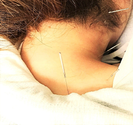 こまち鍼灸整体院Grulla 鍼灸治療のメニュー画像