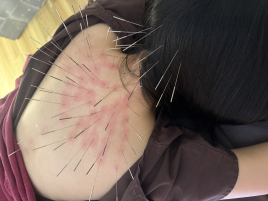 鍼灸処 Gene ルート鍼治療のメニュー画像