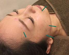 SUNplus等々力鍼灸院 美容鍼＋鍼灸＆マッサージ30分のメニュー画像