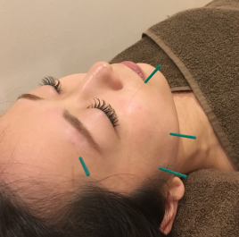 SUNplus等々力鍼灸院 美容鍼30分のメニュー画像