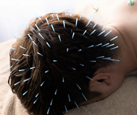 グラン治療院東京 頭の鍼のメニュー画像