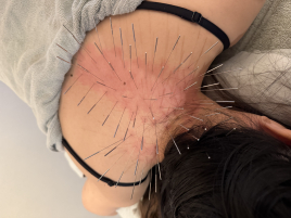 鍼灸&スポーツマッサージ Revive スポーツマッサージ×ルート治療のメニュー画像