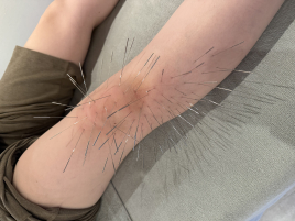 鍼灸&スポーツマッサージ Revive スポーツマッサージ×ルート治療×微弱電流のメニュー画像