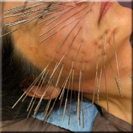 みゅう東京 ルート鬼美容鍼のメニュー画像