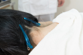 たしろ鍼灸院 肩こり・首こり鍼灸施術のメニュー画像