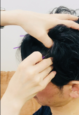 なな鍼灸院 YNSA頭針療法・慢性痛・しびれ・痛みのメニュー画像