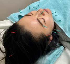 せせらぎ鍼灸整骨院 美容鍼のメニュー画像