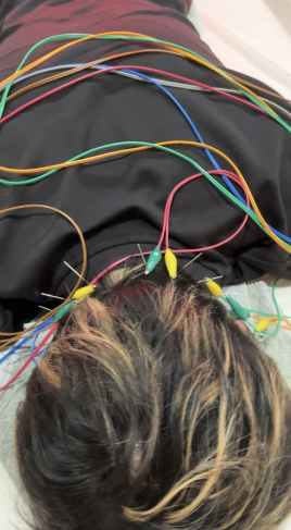 alpha（アルファ）鍼灸院 鍼灸のメニュー画像