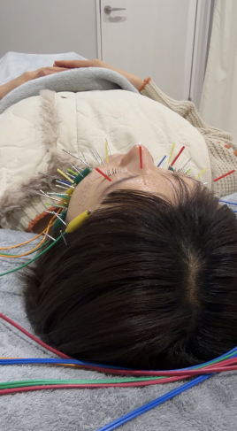 alpha（アルファ）鍼灸院 美容鍼オプション　小顔リフトアップ鍼のメニュー画像