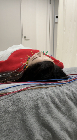 alpha（アルファ）鍼灸院 美容鍼オプション　美白鍼のメニュー画像