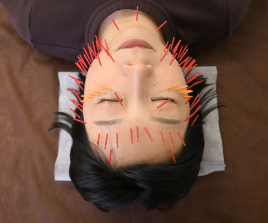 肌質改善専門 美容鍼デイジー谷町六丁目店 人気No.1！スタンダード100本コースのメニュー画像