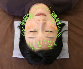 肌質改善専門 美容鍼デイジー谷町六丁目店 贅沢フルコース！プレミアム120本コースのメニュー画像