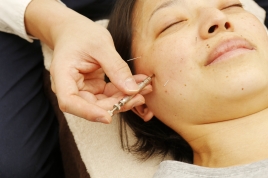 アスケア治療院 美容鍼のメニュー画像