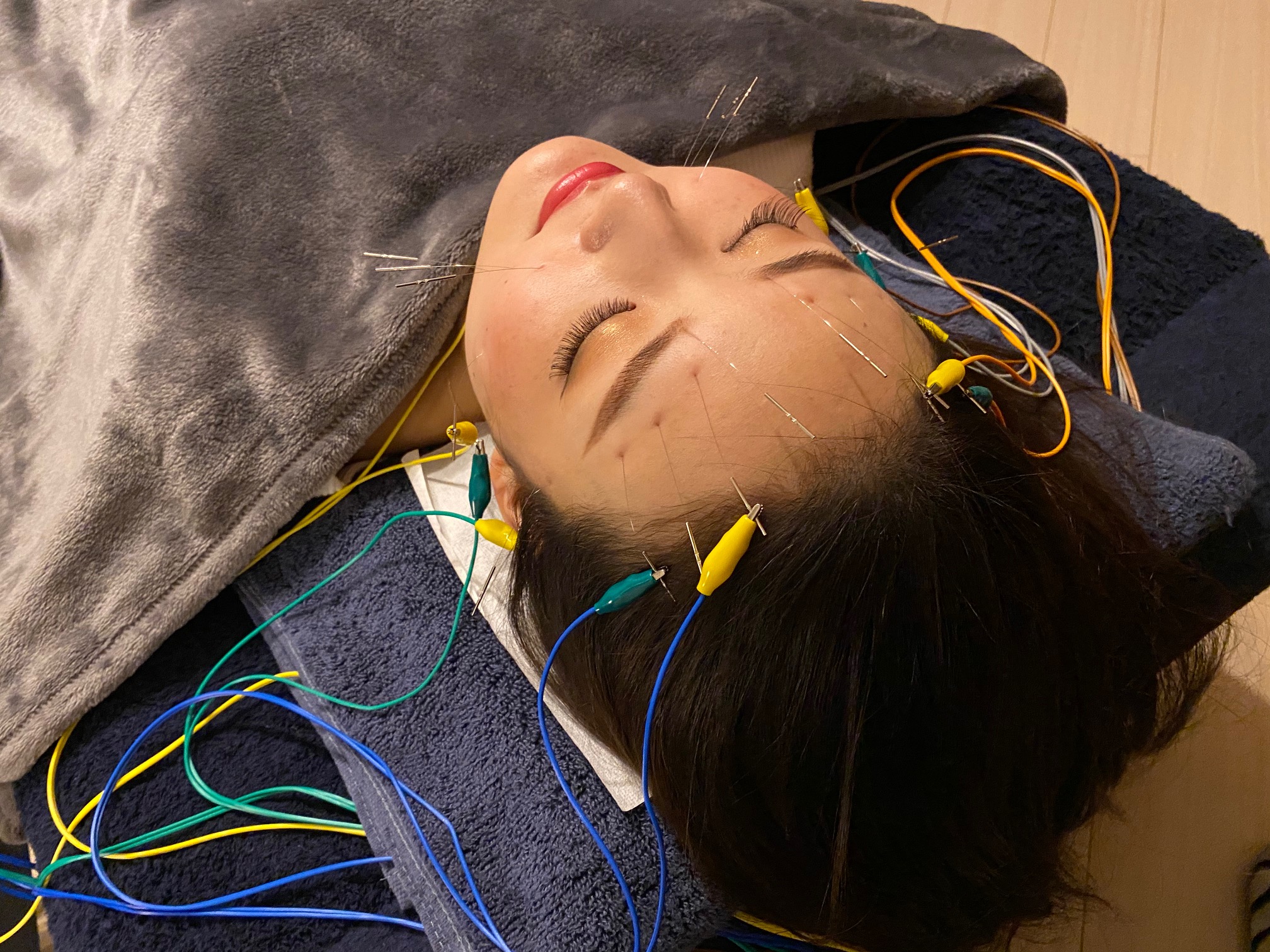 シュエット BODY CARE / 治療院 電気を流す美容鍼BASICのメニュー画像