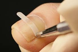 國安鍼灸整骨院　中野院 巻き爪補正のメニュー画像