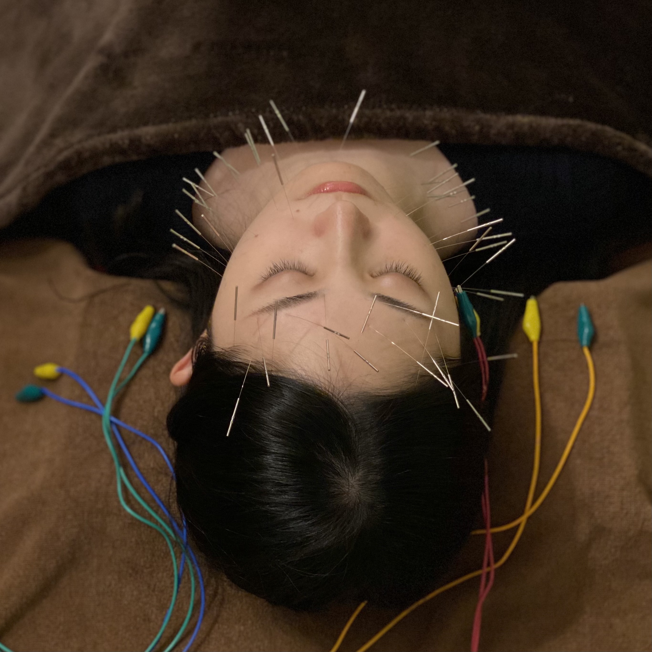 鍼灸マッサージLifeBuddy ● 【初回限定・42本】顔全体に電気を流す美容鍼のメニュー画像