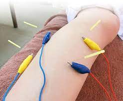 國安鍼灸整骨院　中野院 鍼局所治療（１部位のみ）のメニュー画像