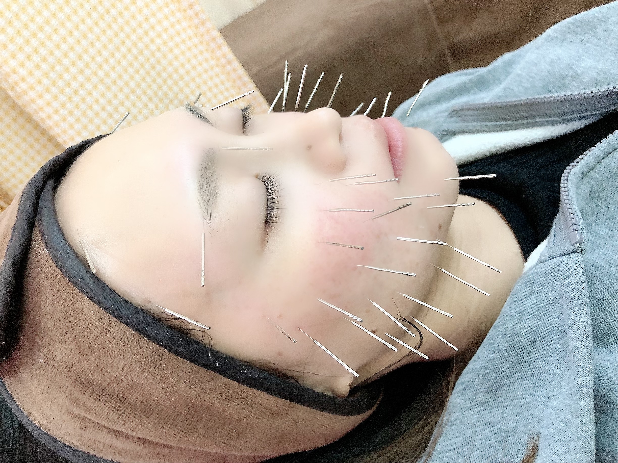 セントラル鍼灸院Re:laxy 美容鍼（キメのお悩みの方）16500が２回目からもお得のメニュー画像