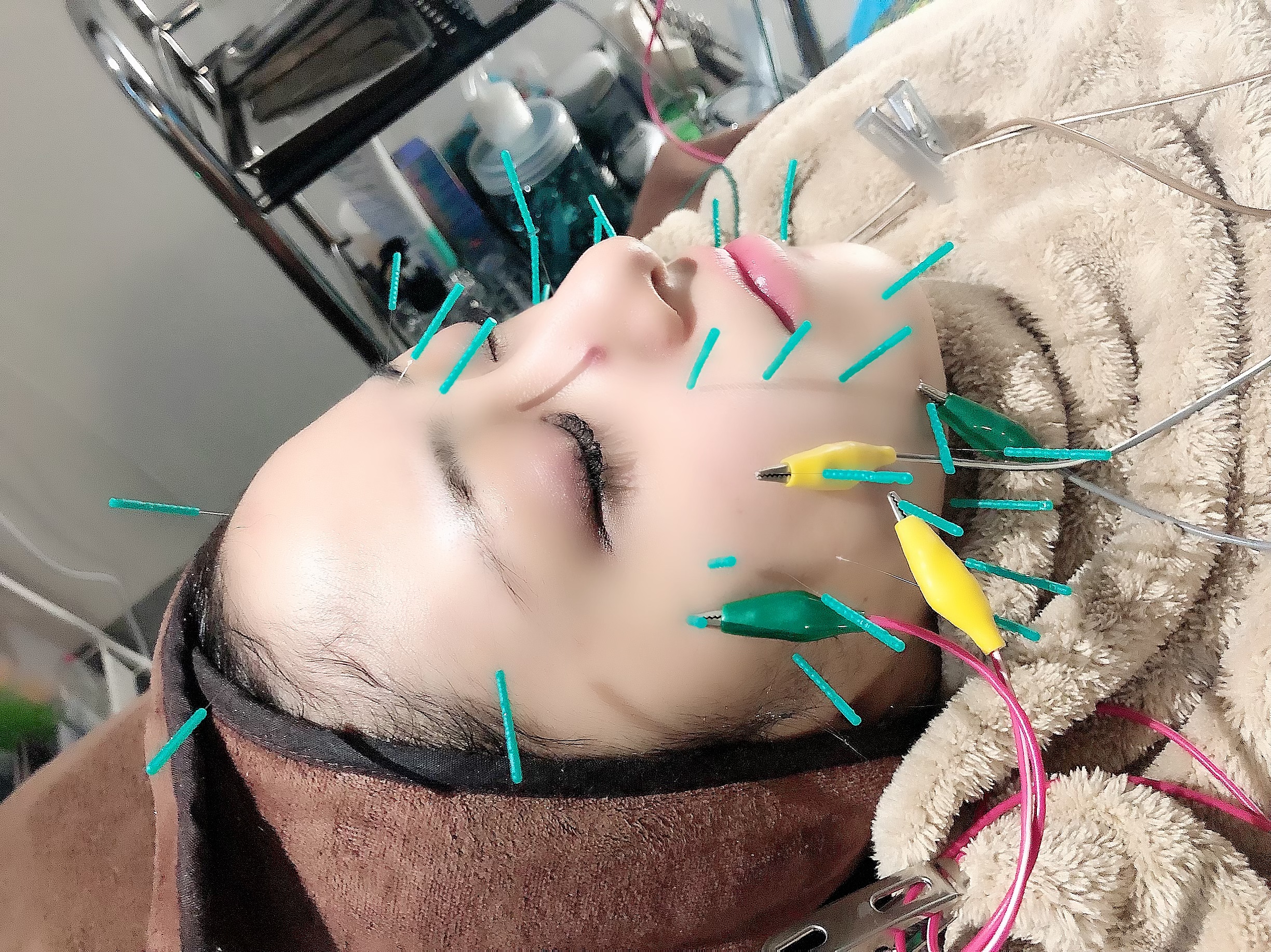 セントラル鍼灸院Re:laxy パルス美容鍼/2回目以降前回より17600円→ 1ヶ月まではお得に 14400円のメニュー画像