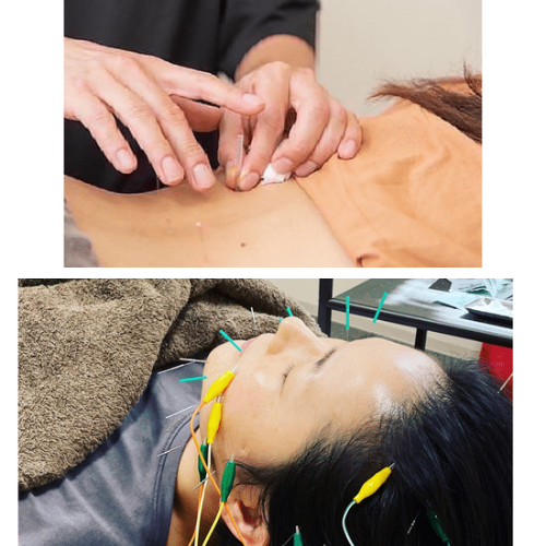UNI health&beauty 美容鍼+全身鍼灸コース(身体メンテナンス)のメニュー画像