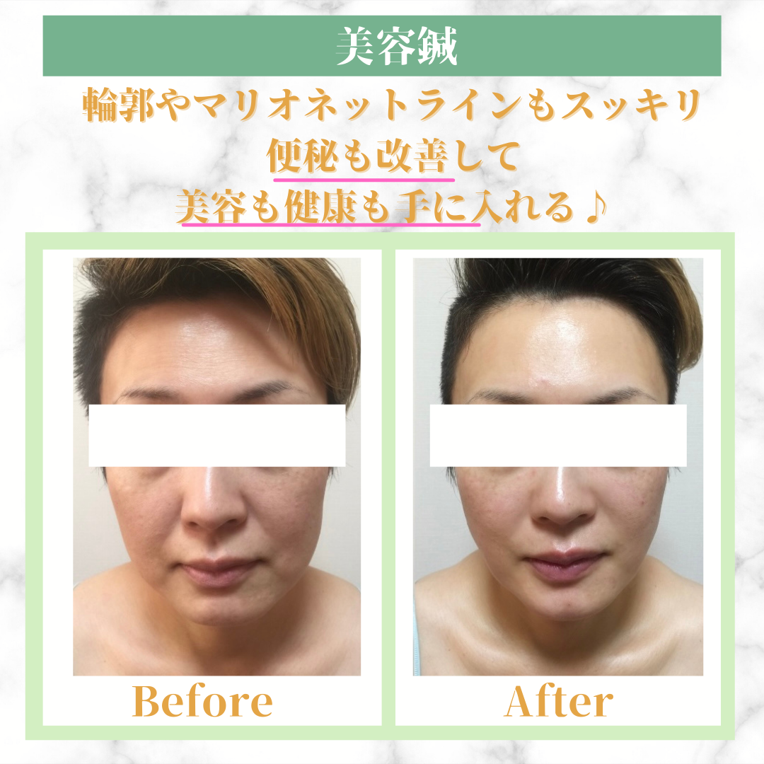美容鍼灸エステサロン・アール自由が丘 【体験】小顔効果抜群！・シワたるみ改善美容鍼のメニュー画像