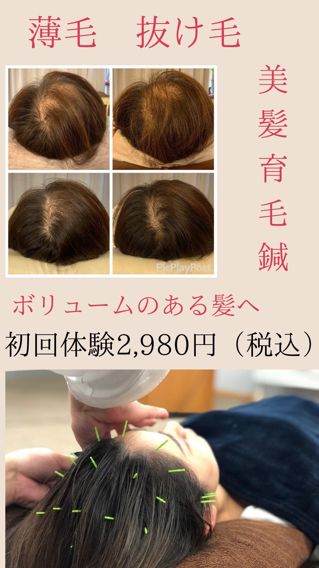 HaRick 美容鍼灸整体 女性の為の育毛美髪鍼（お試し価格）のメニュー画像