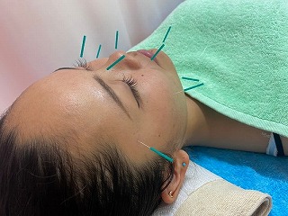 國安鍼灸整骨院　中野院 美容はり（全身鍼灸併用）のメニュー画像