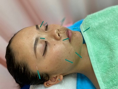 國安鍼灸整骨院　中野院 美容はりのメニュー画像