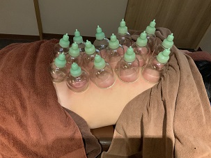 ふくろう針灸院 カッピングのメニュー画像