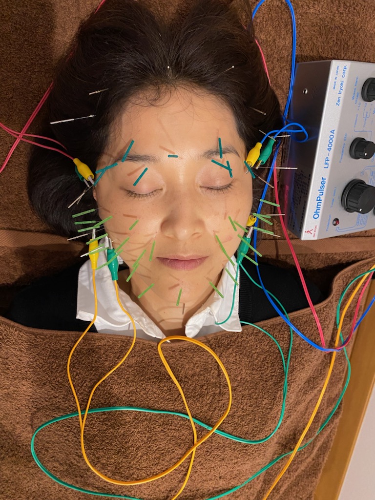 鍼灸院 侑秀 NIIGATA (リピーター限定)侑秀オリジナル美容鍼コースのメニュー画像